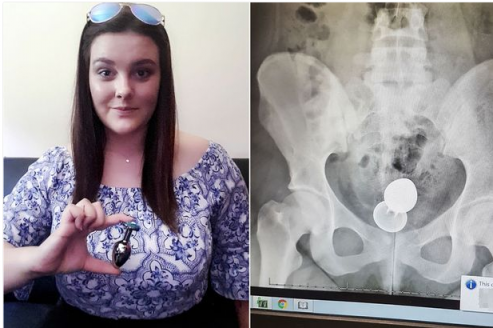 A young woman had a four-inch sex toy surgically removed from her bottom af...